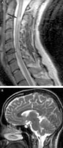 Acupuncture for Multiple Sclerosis and Classical Chinese Medicine for MS