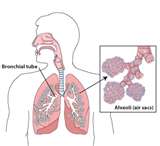 Herbs and Acupuncture for Bronchitis