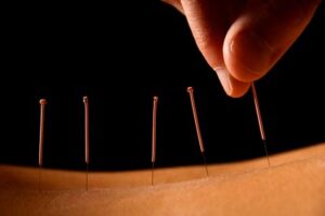 Acupuncture for Nerve Pain and Nerve Damage