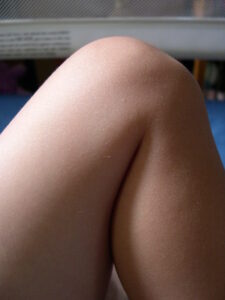 Acupuncture for Hip and Knee Pain
