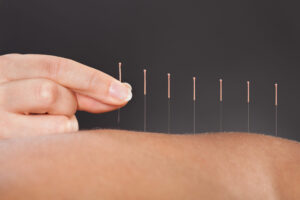 Acupuncture as an Alternative Therapy for Pain Management