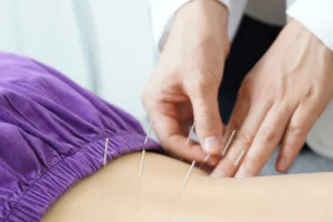 Acupuncture